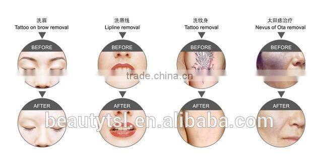 Q switch nd yag laser hair removal machine