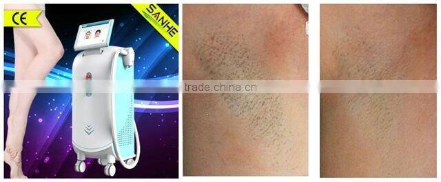 Alexandrite laser professional 808nm diode laser hair removal machine