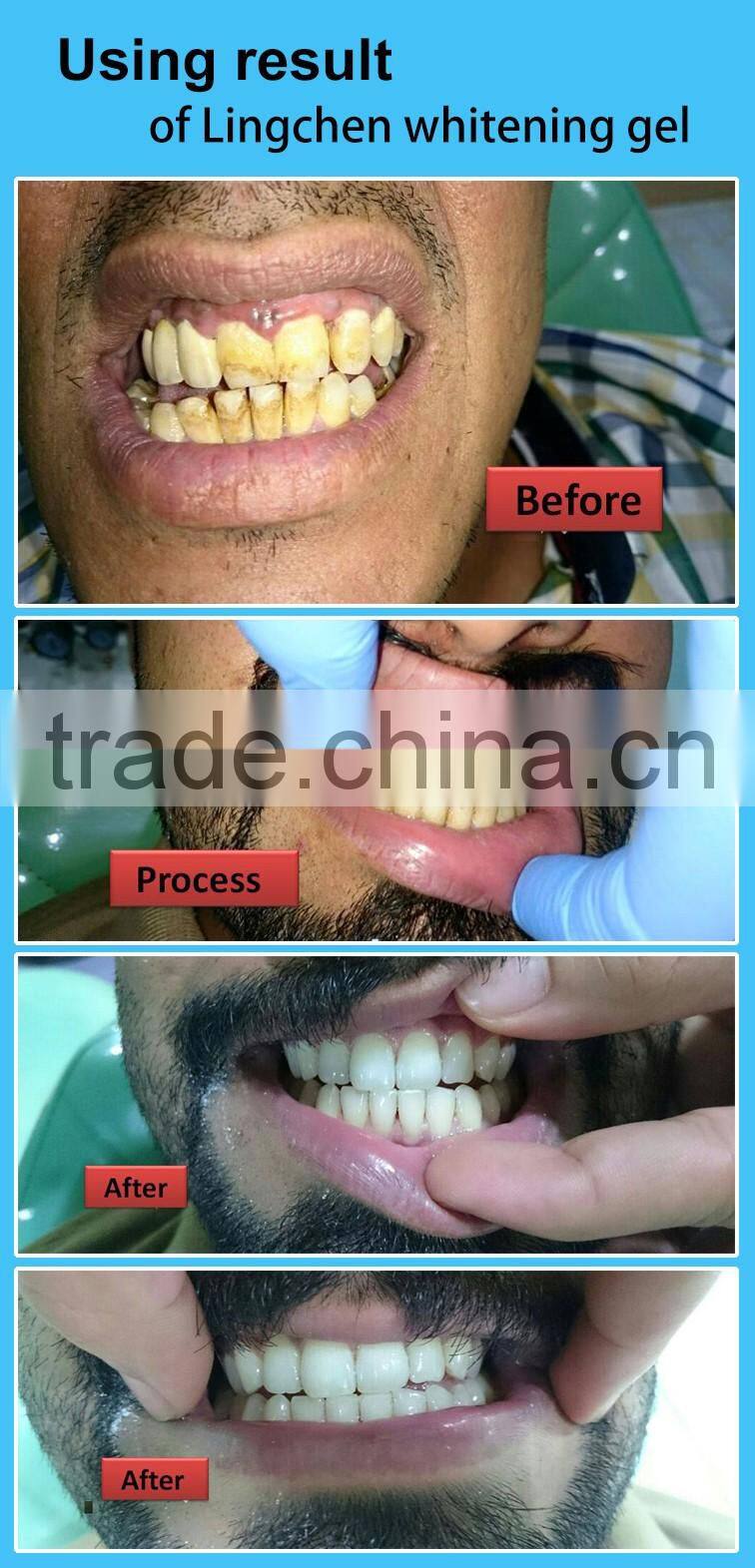 2016 the newest dental gum protection gel for teeth whitening kit