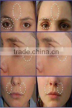 VY-638B Black heads removal and ultrasonic for whitening skin