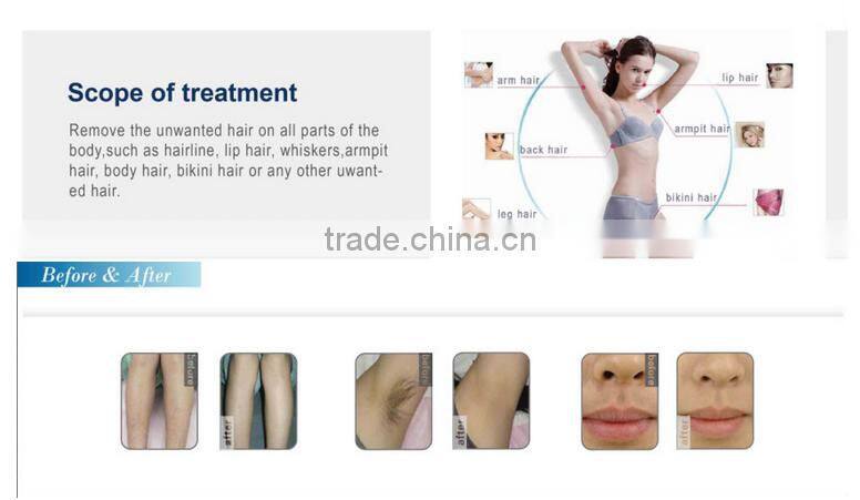 2016 high power effective laser 808nm hair removal machine laser removal