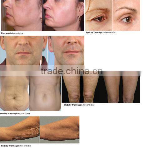 2014 hot product fractional microneedle radiofrequency skin tightening