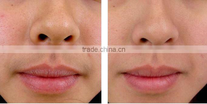 810NM DIODES LASER HAIR REMOVAL machine