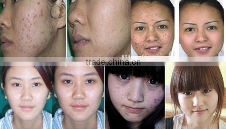 Water Oxygen Jet machine for Sun-damaged skin treatment