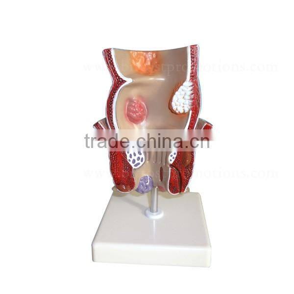 Rectum Pathology Organs Education Human Body Anatomy Model