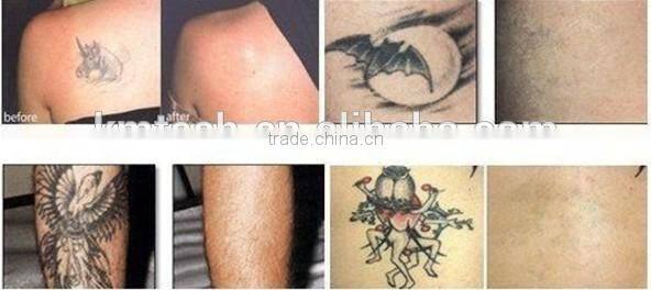 1064nm Long Pulse Laser Hair Removal Machine