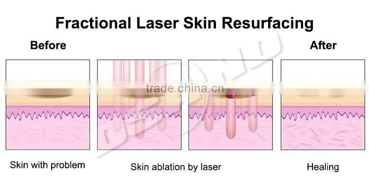 Q-switched Nd Yag Laser Eyeline Removal / Hair Removal Machine