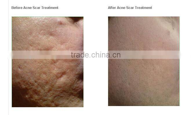 Mini IPL Skin Rejuvenation Machine/ Best Permanent Hair Removal IPL Beauty Device