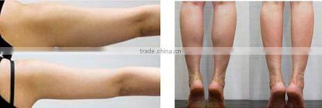 hifu machine for wrinkle removal body slimming