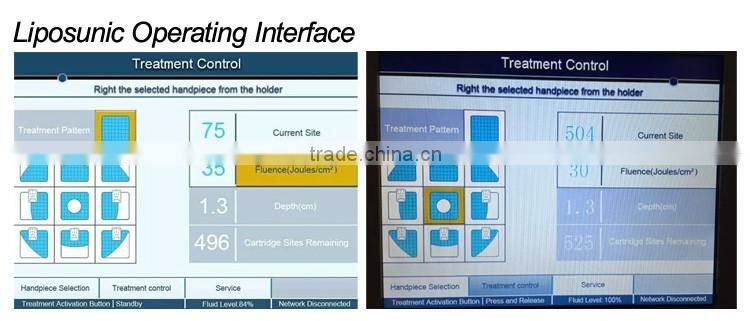 new technology high intensity focused ultrasound whole body fat reduction