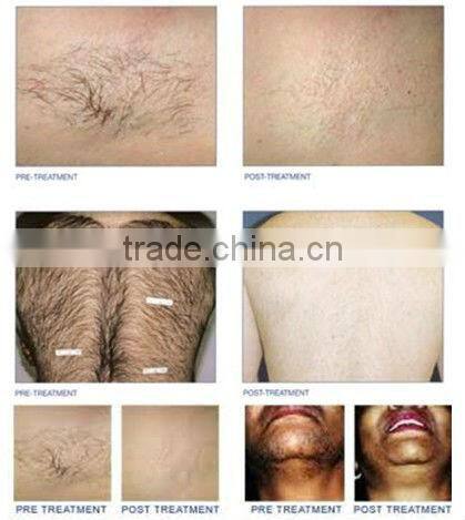 Top quality low price salon machine professional high performance diode laser hair removal fda approved