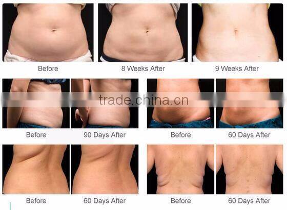 4 In 1 cryolipolysis fat freeze slimming machine/cryolipolysis/best cryolipolysis machine for sale