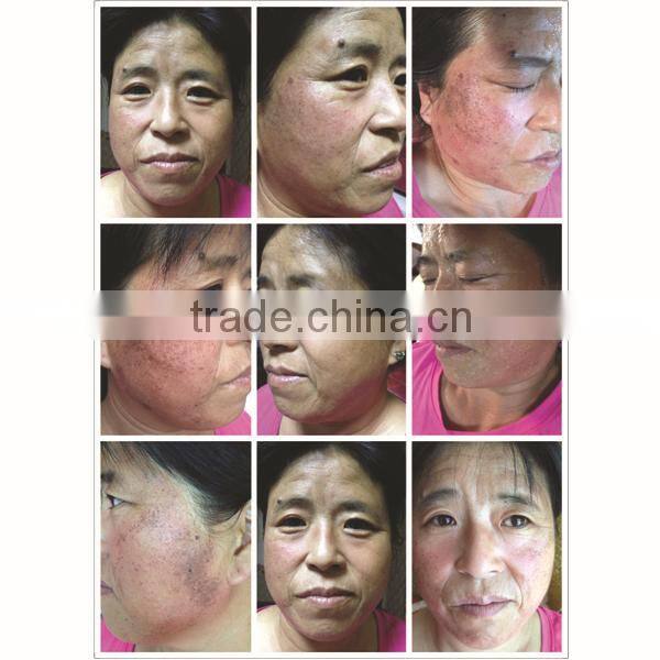 multifunction elight rf laser multi light ipl machine 3 in 1 facial care system