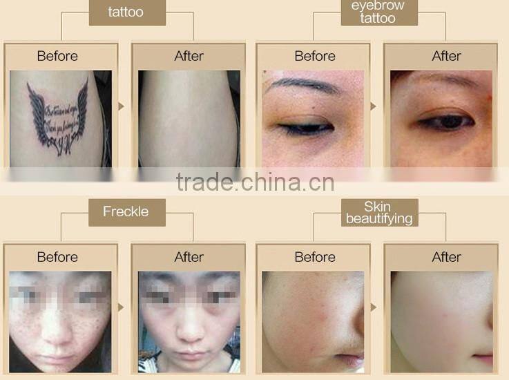 Professional Tattoos removal medical laser machine 532nm/1064nm Q-switched Nd-YAG Laser