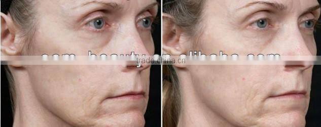 Medical spa equipment wrinkles removal iontophoresis rf machine F-JT01