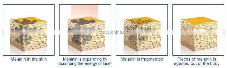 Product Description High quality hot sale !! 532&1064nm Q switch nd yag laser tattoo removal machine