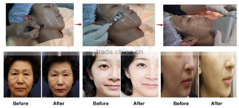 Non-invasive HIFU face lift high intensity focused ultrasound beauty machine