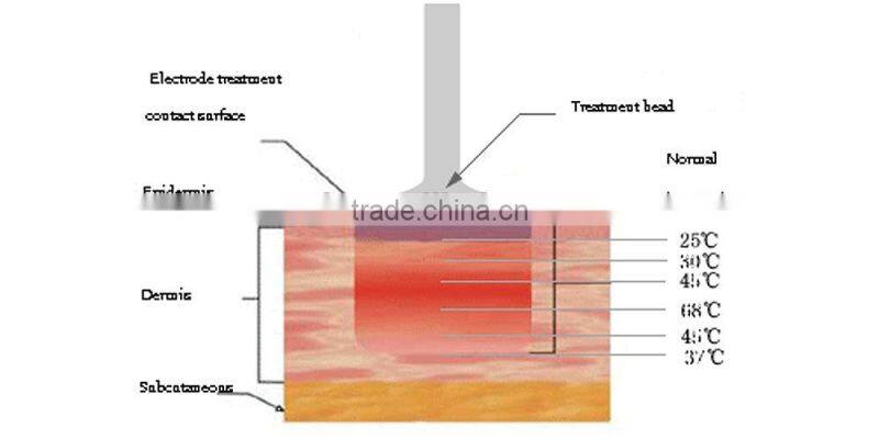 face lift skin rejuvenation pigment correcting RF slimming beauty machine