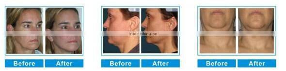 latest technology instant effect skin tightening hifu face lift