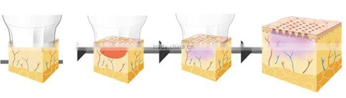 AYJ-T29(CE) Professional CPT fractional rf device for anti-wrinkle