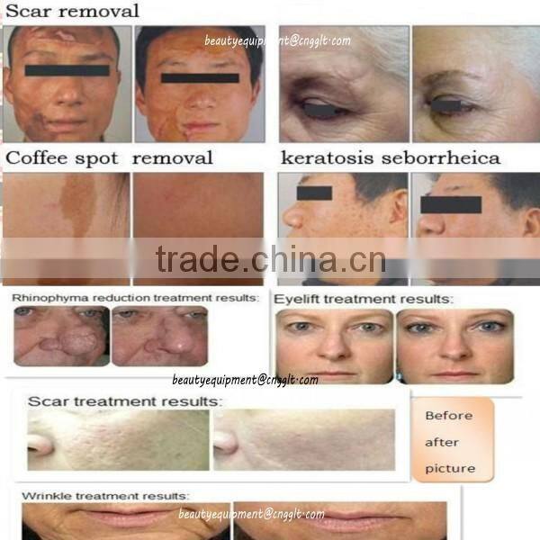 Scar/Wart/Acne Removal Fractional CO2 Laser