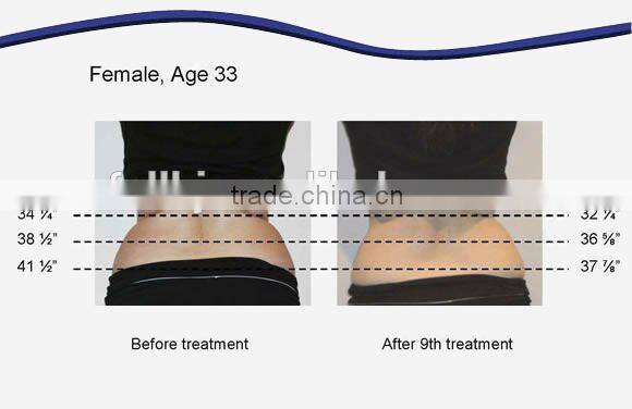 Economical and professional Lipo laser / diode laser slimming / Laser slimming machine