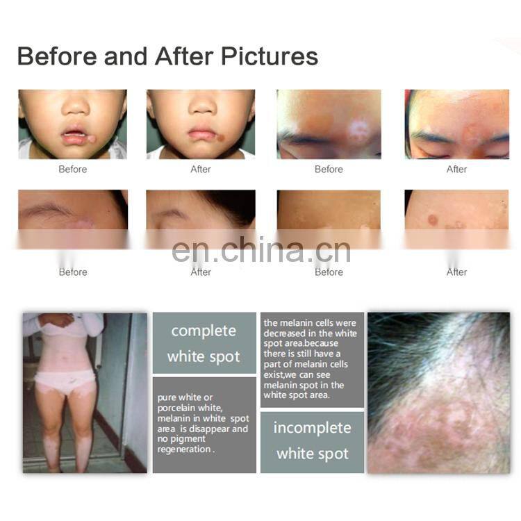 308nm excimer laser vitiligo phototherapy instrument genuine home UVB UV treatment machine