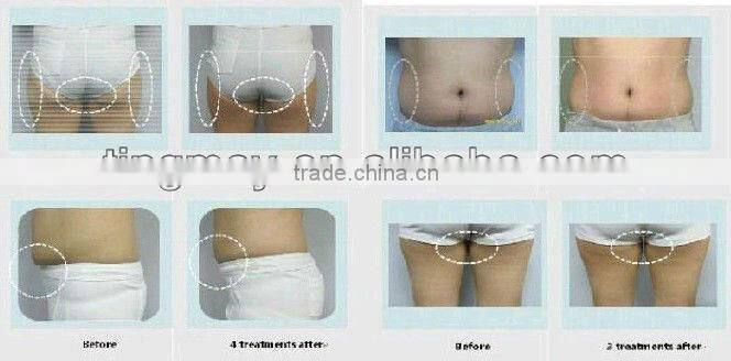 hot sale 40Khz (cavitation)ultrasound fat burning machine