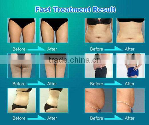 Hot sale! Powerful rf radiofrecuencia skin tightening with hot promotion