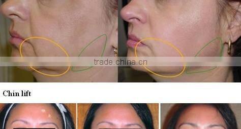 China factory offer portable RF beauty machine with two handpieces