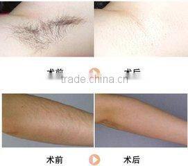 755nm Alexandrite laser machine with optimal & supper handle to remove hair painless