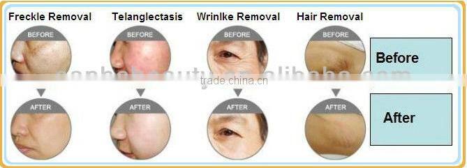 2016 professional portable SHR for hair removal and skin rejuvenation/ hair removal electrolysis machine/ hair remover with puls