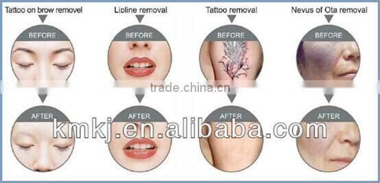 Hot Selling Nd-YAG Laser Q-Switch Tattoo Removal Machine Price