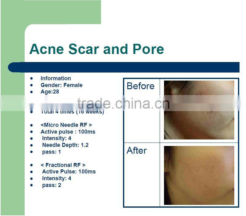 New arrival oem skin whitening pinxel microneedle fractional radio frequency