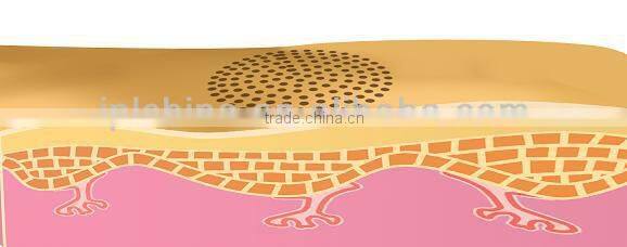 2015 new hot sale beauty radiofrequency rf laser skin rejuvenation device