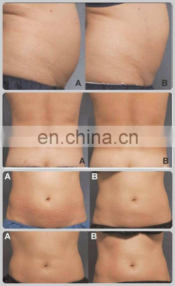 2019 Fashion best lipolaser 650 slimming machine 650nm lipo laser