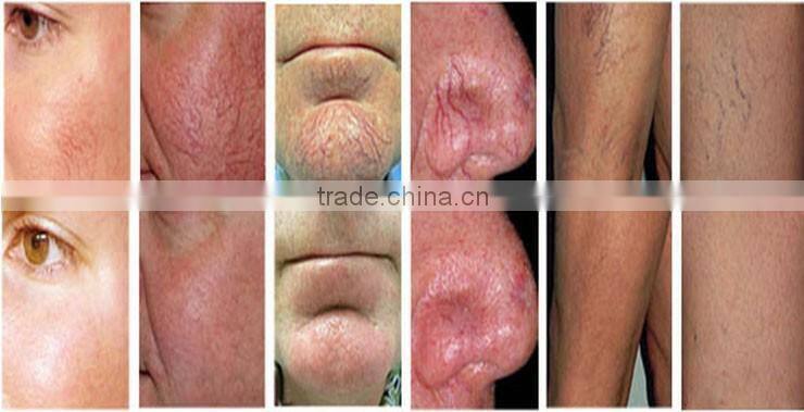 Alibaba sell 980nm diode laser Vascular Removal, Diode Laser Vascular Spider Vein Removal Machine