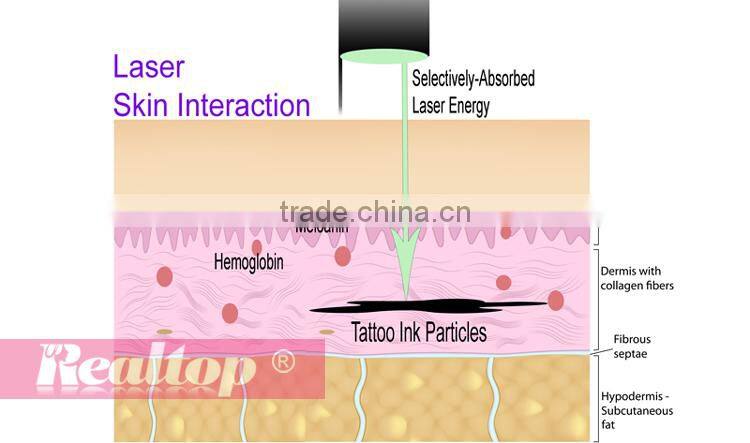 Distributors wanted 1064 nm & 532nm q switch nd yag laser tattoo removal machine for Tattoo Birthmark Freckle Removal