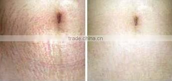 Most hot selling :skin care tools L005