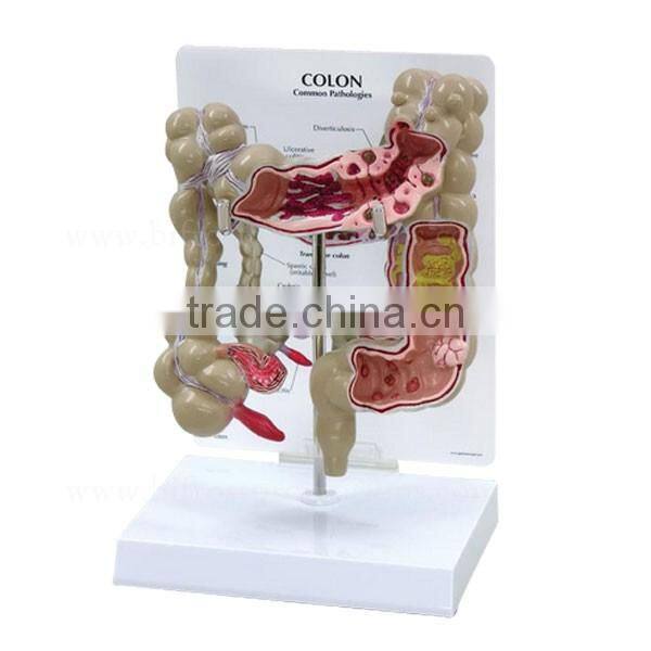 Pathology Colon Model Organs Human Body Anatomy