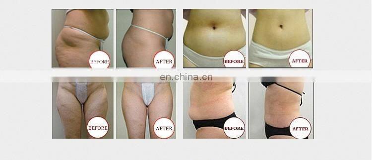 4 Treatment Head Cryolipolysis Vacuum Fat Freezing Machine Body Contouring Non Invasive Treatment Beauty Product