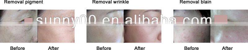 Portable Surgical Co2Laser For Scar Removal -ivy 2013062524