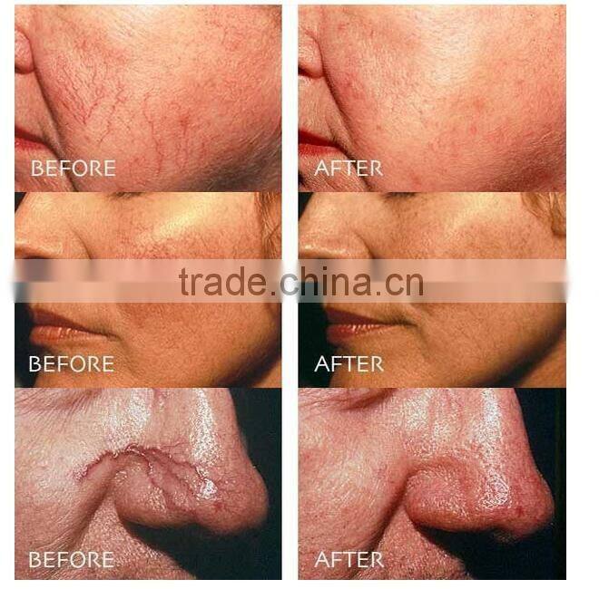 Portable Professional Vascular Removal / Spider Vein Removal Machine/spider Vein Vascular Removal 980nm Diode Laser