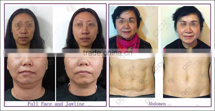 (CE Certificated) Non Surgical Mesotherapy Facial Firming Machine for Wrinkle Reduction&Fine Line Care R80