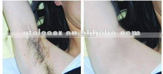 alexandrite machine price / alexandrite laser hair removal machine factory price