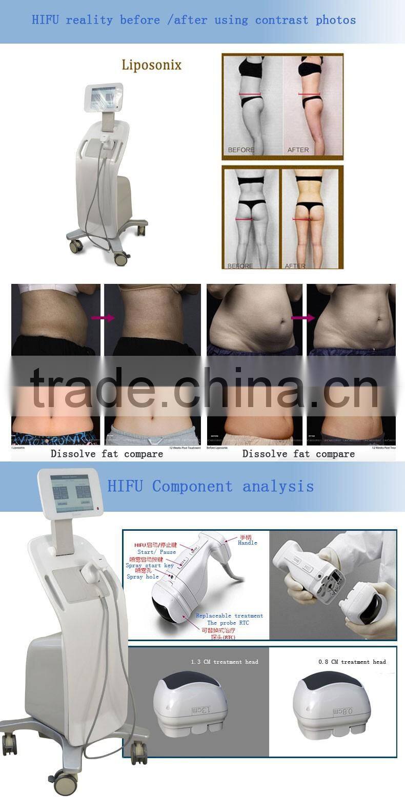 2016 Hot sale lipo hifu slimming machine for weight loss