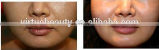 Beauty equipment multifunctional machine hair removal 2015