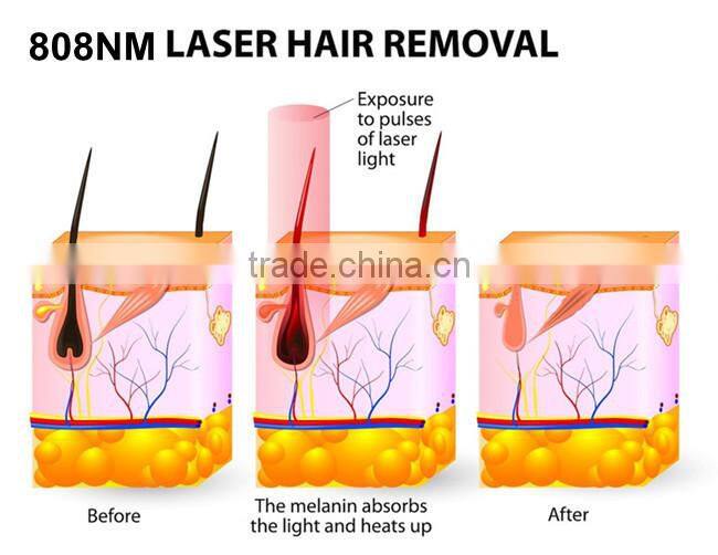 Lady Epilator atraumatic hair removal laser diode AM-300