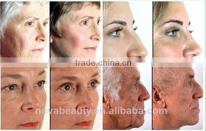 NV-CR400 portable home use beauty equipment beautiful and practical rf skin tightening machine for novabeauty equipment