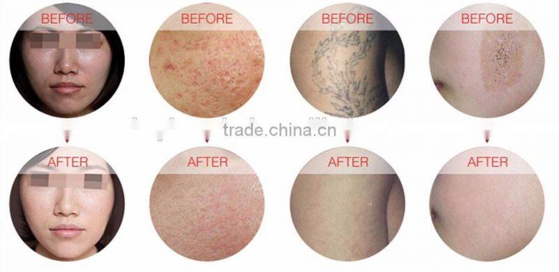New products 2016 532nm/1064nm/1320nm 3 different heads yag laser tattoo removal